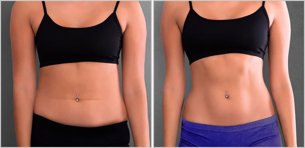 Two images of a woman's stomach before and after liposuction.