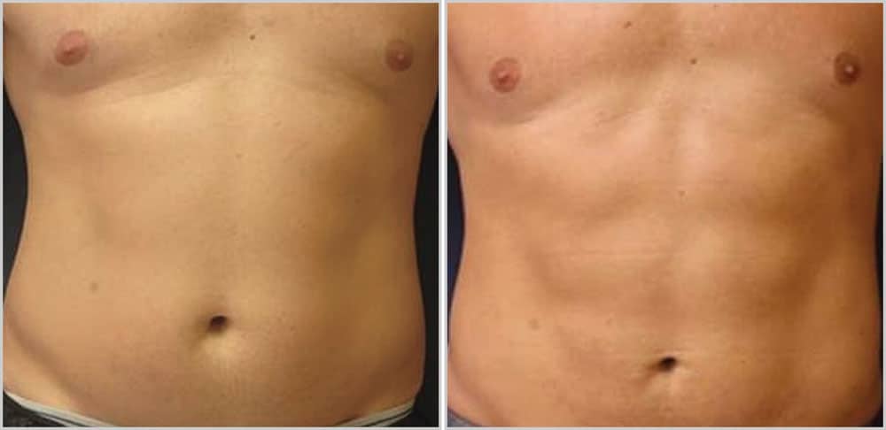 Tummy tuck before and after.