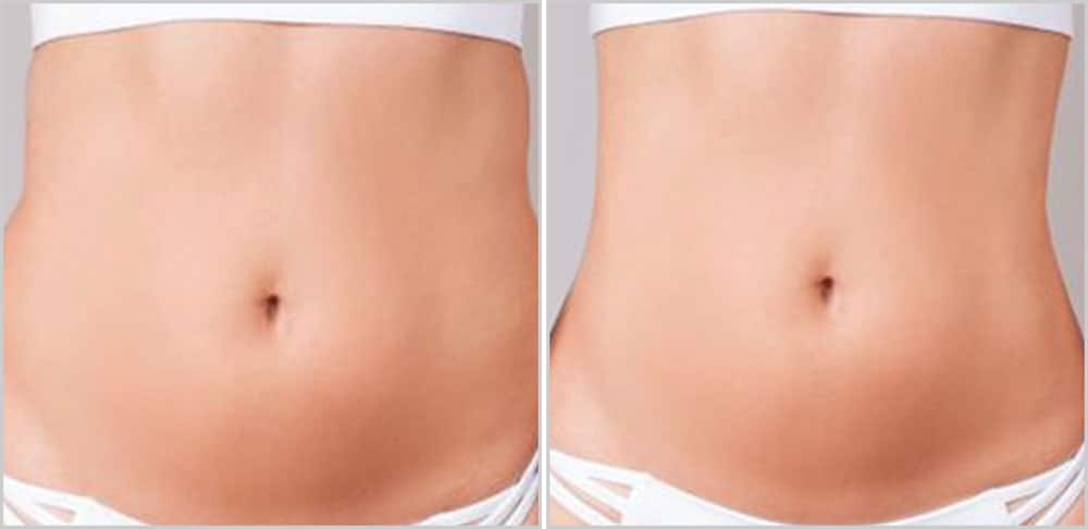 A woman's stomach before and after liposuction.