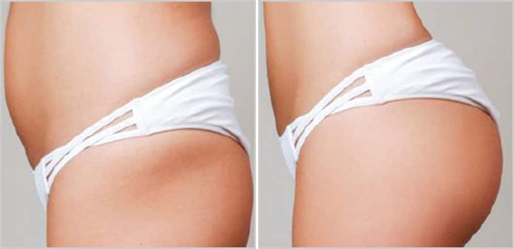 A woman's butt before and after a liposuction treatment.
