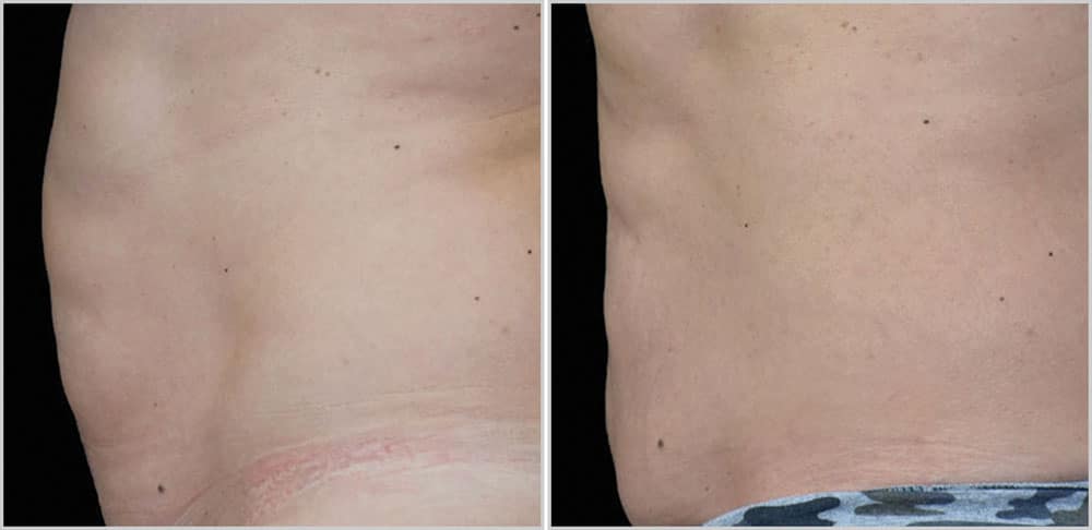 Tummy tuck before and after.