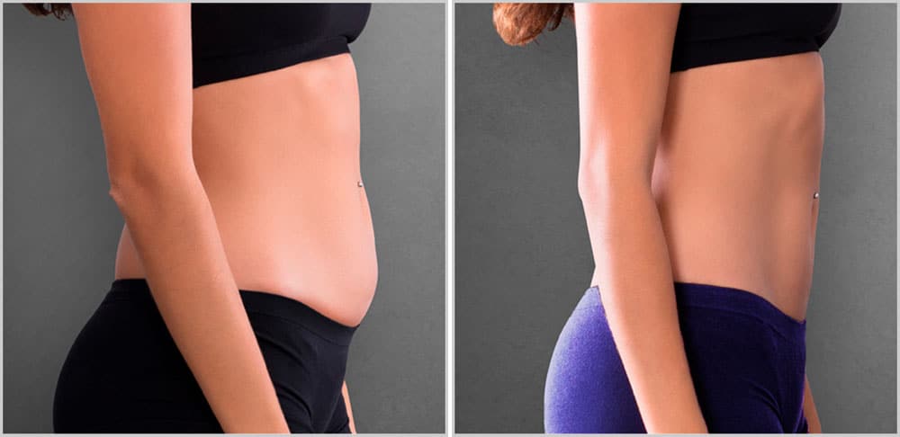 A woman's stomach before and after liposuction.