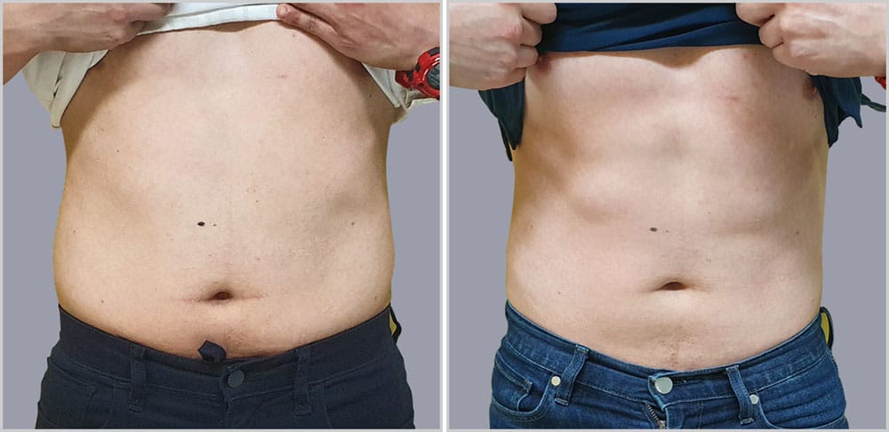 Tummy tuck before and after.