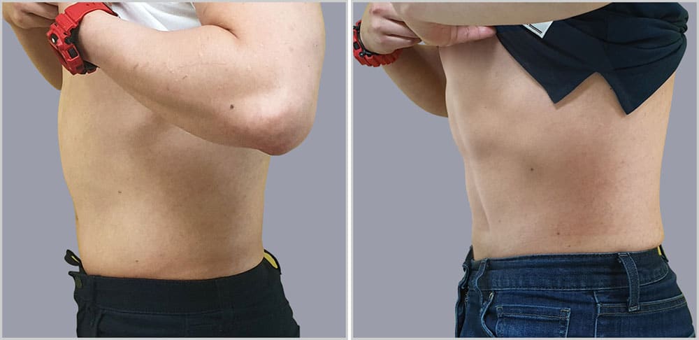 Two pictures of a man before and after liposuction.