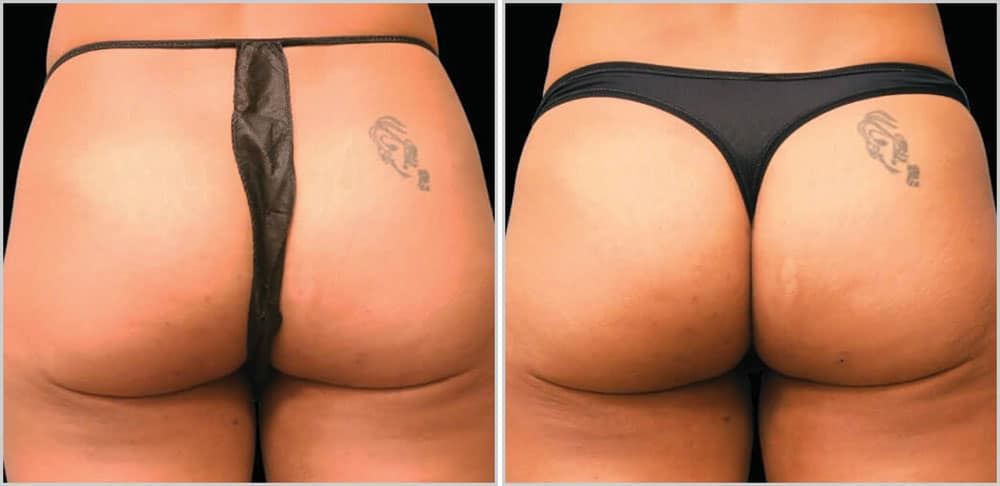 Before and after pictures of a woman's butt.